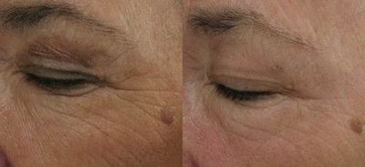 Crows feet and eye wrinkles treated with 1 treatment of Lux 1540 Fractional Laser - 
	Crows feet and eye wrinkles treated with 1 treatment of Lux 1540 Fractional Laser.&nbsp;

