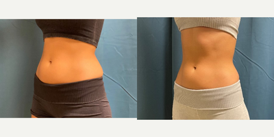 25-34 year old woman treated with Emsculpt - Amazing results in just 3 months on Emsculpt