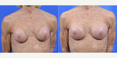 55-64 year old woman treated with Breast Implant Revision - A woman in her 60s who had contractures of both silicone breast implants with rupture placed many years ago. She underwent major revision with removal of the abnormal capsules and placement of new, round 295 cc silicone textured implants. These were placed above the muscle due to her muscular frame to prevent animation deformity. We were unable to use shaped implants due to concern for rotation in this revision procedure.