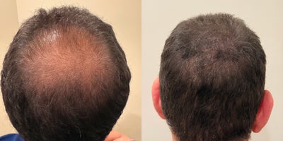 35-44 year old man treated with Scalp Micropigmentation - before and after SMP treatment for a Male patient desiring more fullness to the crown and mid scalp.