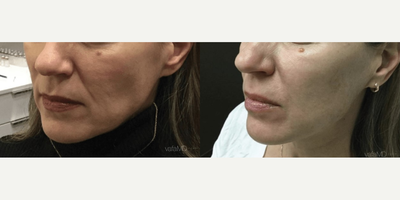 Woman treated with Sculptra - Woman treated with Sculptra