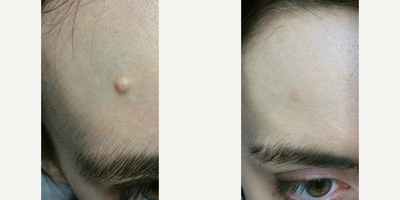 Woman treated with Mole Removal - Woman treated with Mole Removal
