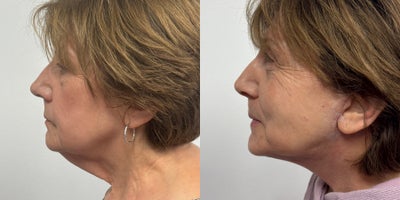 55-64 year old woman treated with Neck Lift - 4 weeks after a neck lift