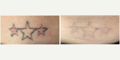 Woman treated with PicoSure - Laser tattoo removal
