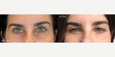 35-44 year old woman treated with PlasmaPen - 1 Month post PlasmaPen used to treat hollow, tired looking eyes.