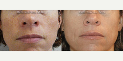 35-44 year old woman treated with Laser Genesis - Seeking to improve her image this patient underwent a Laser Genesis with Suzanne our Registered Nurse, Certified Laser Nurse Specialist.