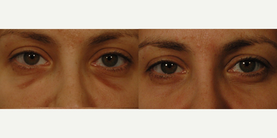 45-54 year old woman treated with Laser Treatment - Q-switched laser treatments for hemosiderin staining before and after 2 treatments. Long term, deep bruising that creates darkening of the skin under the eyes is known as hemosiderin staining. Although not very common, it can create much distress for patients that have had this happen. The pictures show what q-switched lasers can do after just a couple treatments. This patient was injected at another practice with Radiesse under the eyes.