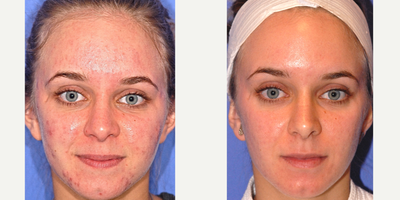 18-24 year old woman treated with Blue Peel - Acne Treatment with smooth beam then a Blue Peel to finish results