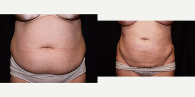 Laser Liposuction - Abdomen - Abdomen