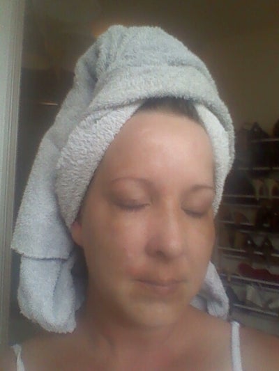 I Have Had Melasma For Over 5 Years And It Is Finally Going Away