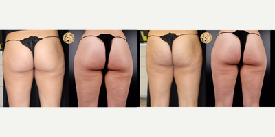 18-24 year old woman treated with Cellfina - Great results from the Cellfina procedure. Clinically proven to reduce the appearance of cellulite!!