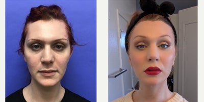 Patient treated with Forehead Reduction, Brow Lift, Revision Rhinoplasty, Cheek Augmentation, Facial Feminization Surgery, Trans - 25 to 34 year-old female patient is 2 years 8 months post-op from Facial Feminization surgery. Her procedures included: Forehead Lift, Hairline Lowering, Orbital Bony Contouring, Septorhinoplasty Revision (closed) with Cartilage Grafts, Cheek Implants (small), Chin Reduction and Contour, Soft Tissue to Nasolabial Folds, Intranasal Lip Lift with Fat Augmentation, Thyroid Cartilage Shave Revision, and Voice Feminization, 300 Micrografts. Patient is 1 year post-op from 450 Micrografts to Recessions.