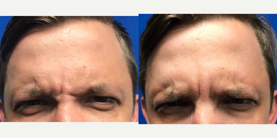 25-34 year old man treated with Injectable Fillers - Botox injection in the forehead and between the brows to reduce wrinkles.