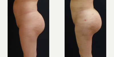 Brazilian Butt Lift Revision - The patient had a previous Brazilian Butt Lift and butt implant surgery out of town. She was happy with the projection of her butt, however she wanted to revise some of the liposuction areas and improve her overall shape. She underwent revision liposuction and fat transfer to transform her shape form square to more of an hourglass figure.