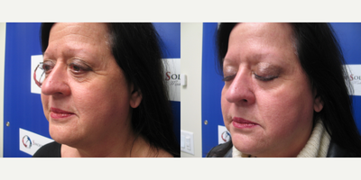 Woman treated with Botox - Woman treated with Botox.