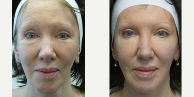 55-64 year old woman treated with Radiesse - Patient treated with radiesse to jawline, chin and undereye