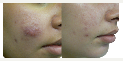 35-44 year old woman treated with Spironolactone For Acne, YAG Laser, Laser Resurfacing, CO2 Laser - A safe and effective way to treat acne (even cases resistant to conventional therapies), improve the skin and minimize scar formation.What are the benefits?Laser acne treatment offers a no down-time approach to help clear acne lesions and help reduce severity of future breakouts. You can return to work or school immediately after treatment. The only side effect will be slight facial redness. Laser treatments do not have the side effects seen with oral and topical treatments. Laser treatment DO NOT induce prolonged dryness, severe redness, or mental depression.How does it work?Dr. Rafael Diaz-Yoserev will analyze your skin condition and help you select the most effective treatment for you.When will you see results?Effects are cumulative. After the first treatment, you might see improvements. The number of lesions and severity of breakouts should reduce over the course of treatments and beyond. Some patients continue to improve two months after their last treatment.How often can you have it done?The typical course of treatments is 2-3 weeks, 2-3 treatments per week.