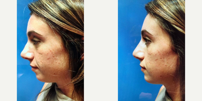Woman treated with Nonsurgical Nose Job - Woman treated with Nonsurgical Nose Job and Chin Implant