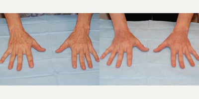 55-64 year old woman treated with Hand Rejuvenation - Procedure: Fat injection of hands, laser resurfacing of hands.Before, 3 months after