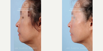 Woman treated with Neck Lift - Woman treated with Facelift combined with Neck Lift