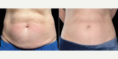 Woman treated with Emsculpt - Woman treated with Emsculpt