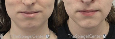 25-34 year old transgender man treated with Facial Feminization Surgery - 25-34 year old transgender man treated with Facial Feminization Surgery