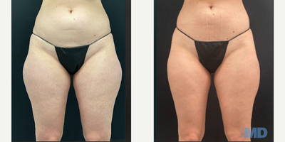 35-44 year old woman treated with BodyTite - BodyTite performed on this patient's flanks/thighs. Lovely results for 1 month post op -- tightening will continue over time.
