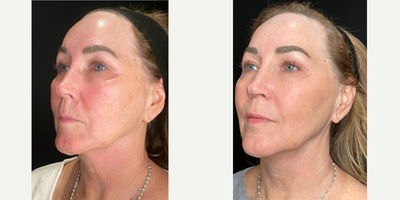 55-64 year old woman treated with Opus Plasma - This client did a series of 3 Opus Plasma treatments and continues to use medical grade skincare daily.