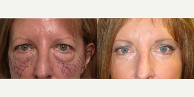 42 year old woman treated with TCA Peel - 42 year old female, who underwent TCA peel, quad-blepharoplasty, and forehead lift.