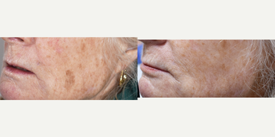 Age spot Removal Los Angeles Before and After photos - They're called age spots because we see more of them over time. If you're sick of trying to use makeup to cover them, come see us about how q-switched lasers can make them disappear in 1 or 2 visits.  IPL and q-switched laser treatments for age spot removal.