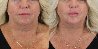 Subtly Transforming our Patient's Face with the Magic of Fillers! - This lovely patient had HA Filler placed in her Lips and Chin to symmetrically add volume, shape, and definition, resulting in plumped and sculpted lips and chin. The enhancements are subtle and we are absolutely loving the naturally refreshed results that were achieved!Our goal at AdmireMD Skin Clinic is to create individually tailored long-term, results-based treatment plans with the aim of improving patients' self-image, enhancing their natural beauty, and boosting their overall confidence and well-being. If you are interested in learning more about Full Facial Balancing, please call 480-781-4016 to schedule a consultation! 