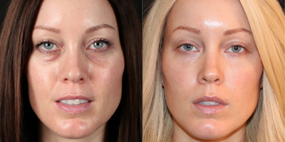 25-34 year old woman treated with Injectable Fillers - Combo procedures performed - Micro-Needling with PRF for skin rejuvenation, Restylane cheek enhancement, PRF under eye injection with micro-cannula, Botox and Juvederm lip augmentation.