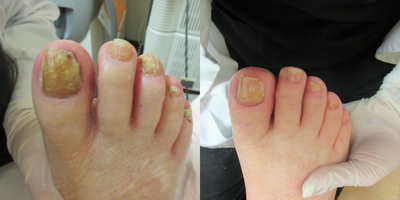 75 and up year old man treated with Laser Toenail Fungus Removal - Nail fungus removal on feet