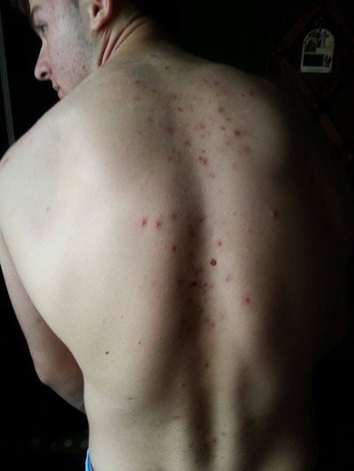 Accutane bad experience essay