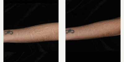 Woman treated with ResurFX - Photo provided courtesy of Lumenis, Ltd., performed by Matteo Tretti Clementoni, MD