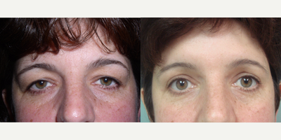 35-44 year old woman treated with Eyelid Surgery - 35-44 year old woman treated with Eyelid Surgery. This patient had her upper eyelids rejuvenated