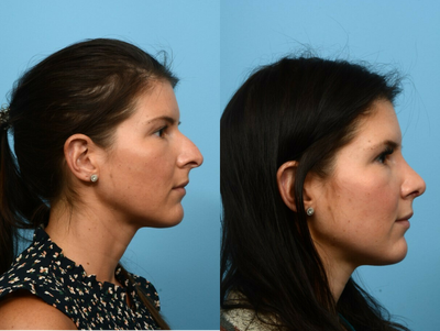 25-34 year old woman treated with Alarplasty - 25-34 year old woman treated with Alarplasty
