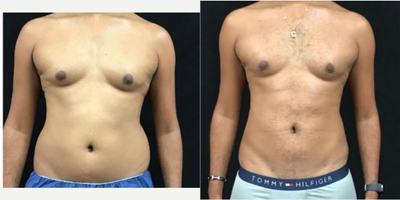 25-34 year old man treated with Skin Lightening - This flexible system offers 1064nm, 1320nm, and 1440nm wavelengths which can be used in single or blended mode. By customizing the wavelengths based on the treatment and patient type, Smartlipo Triplex offers:Tissue retraction through soft tissue coagulation.Reliable, controlled energy delivery.Reduced liposuction procedure time and patient downtime.Less bleeding and bruising than traditional liposuction.Intelligent delivery. Optimal outcomes.Additional technology incorporated to increase safety, optimization, and satisfaction:SmartSense Delivery System distributes precise energy by measuring motion and delivery of laser power.ThermaGuide Temperature sensing cannula provides temperature feedback to deliver the appropriate level of laser energy. How does the smart lipo triplex workstation work?Smartlipo Triplex is designed exclusively to perform laser-assisted lipolysis, commonly referred to as laser liposuction. A very thin tube containing the Smartlipo laser fiber is inserted in targeted fatty areas through a small incision. The laser fiber delivers thermal energy directly to fat cells and disrupts the fatty tissue, allowing the fat to be easily removed through gentle suction. The tissue around the area tightens through coagulation, contributing to an overall smoother shape.
