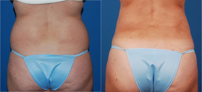35 y/o; vaser lipo treatment for flank lipodystrophy - 
	physically fit patient frustrated with persistent lipodystrophy of her waistline.