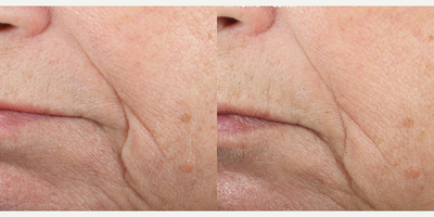 SkinCeuticals, Triple Lipid Restore 2:4:2 - Triple Lipid Restore 2:4:2. A dermatologist-controlled 8 weeks clinical study on 55 subjects with twice daily application of Triple Lipid Restore 2:4:2. Subject also used SkinCeuticals Gentle Cleanser and Ultimate UV Defense SPF 30. Photo provided courtesy of SkinCeuticals