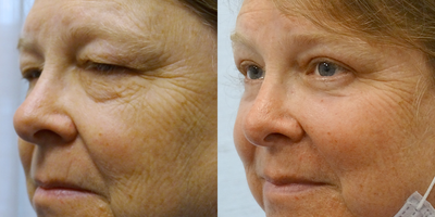 55-64 year old woman treated with Eyelid Surgery - Treated with Ptosis Repair Both Upper Lids, Blepharoplasty Both Upper Lids, and Excision Herniated Orbital Fat Both Lower Lids with CO2 Laser.