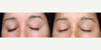 Woman treated with Scar Removal, Laser Scar Removal - Woman treated with Laser Resurfacing.