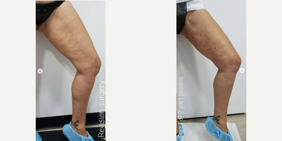 Woman treated with Liposuction Revision - Woan treated with Liposuction Revision