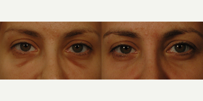 35-44 year old woman treated for removal of Hemosiderin Staining - Patient had under eye injections at another practice and had profound bruising that left long term hemosiderin staining.  Q-switched lasers were used to remove the stains in 2-3 visits.