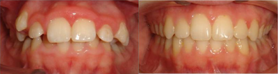 Braces in combination with orthognathic (jaw) surgery - 
	Young woman with vertical maxillary excess, gummy smile and crowded teeth treated with a combination of braces and jaw surgery, for a fabulous result.
