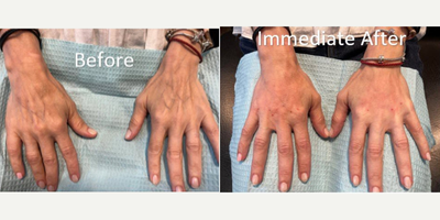45-54 year old woman treated with Hand Rejuvenation - A Bellafill Kit was used to rejuvenate the back of the hands. Bellafill is a long lasting biostimulatory filler with results often lasting 5 years. A microcannula technique was used to minimize procedure trauma/bruising. This is a painless procedure.