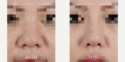 Woman treated with Asian Rhinoplasty - Woman treated with Asian Rhinoplasty