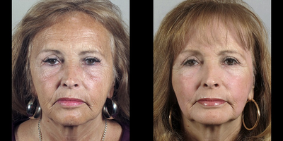 55-64 year old woman treated for Skin Rejuvenation - Dr. Parker performed an upper lid blepharoplasty on the patient to remove her excess skin and a small amount of herniated fat. She returned 3 years later saying she feels she looks tired after years of sun exposure and smoking one pack of cigarettes per day. Dr. Parker discussed options with her and agreed to perform a modified Baker Gordon or Hetter croton oil peel to resurface her facial skin. Dr. Parker told the patient she needed to stop smoking several weeks before the peel and would benefit from preparation of the skin prior to the peel. Several months later, after preparing her skin as advised and not smoking, Dr. Parker performed the croton oil peel.&nbsp;