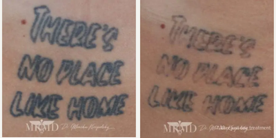 45-54 year old woman treated with Tattoo Removal - Gender: FemaleEthnicity: CaucasianAge: 41 - 50Procedure: Tattoo Removal