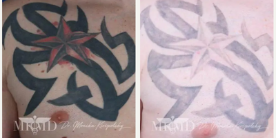 Man treated with Tattoo Removal - Laser tattoo removal  NOTE patient still undergoing treatment.Gender: MaleEthnicity: CaucasianAge: 31 - 35Procedure: Tattoo Removal